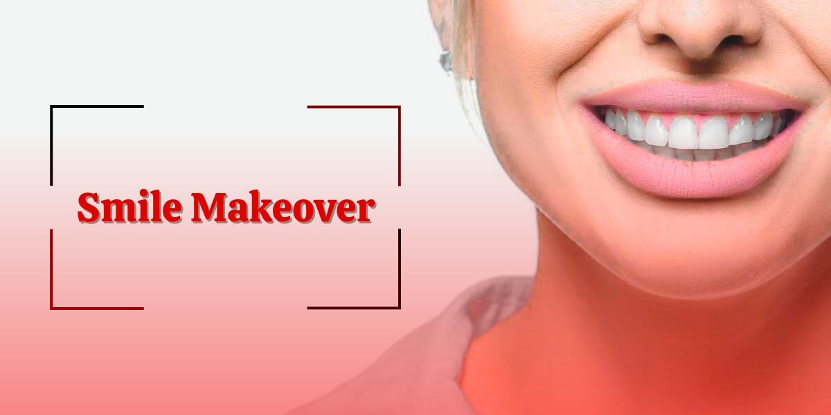 Smile Makeover